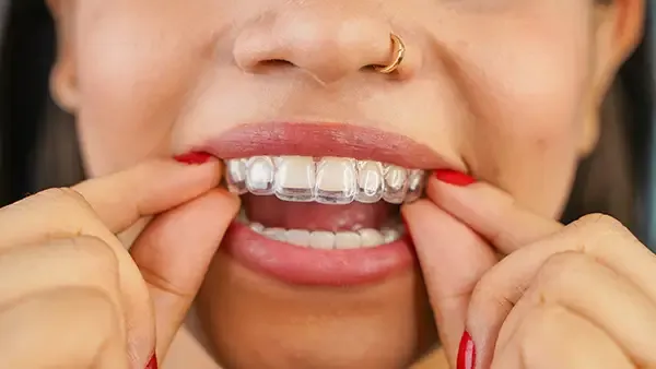 Read more about the article How Forney Patients Are Getting Straighter Smiles with Invisalign