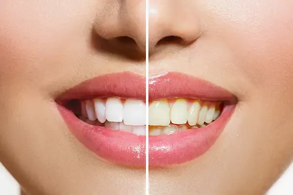 Read more about the article Is Professional Teeth Whitening Better Than At-Home Kits?
