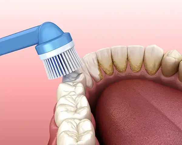 Read more about the article Teeth Cleaning in Forney: What Happens During Your Appointment?