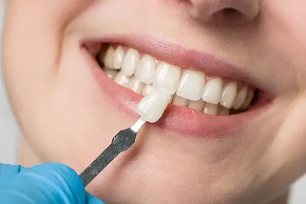 Read more about the article Are Veneers Worth It? Pros, Cons, and Costs Explained