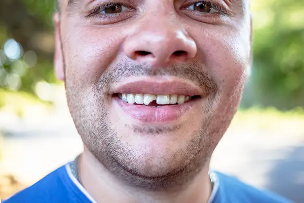 Read more about the article What to Do If You Chip or Knock Out a Tooth in Forney